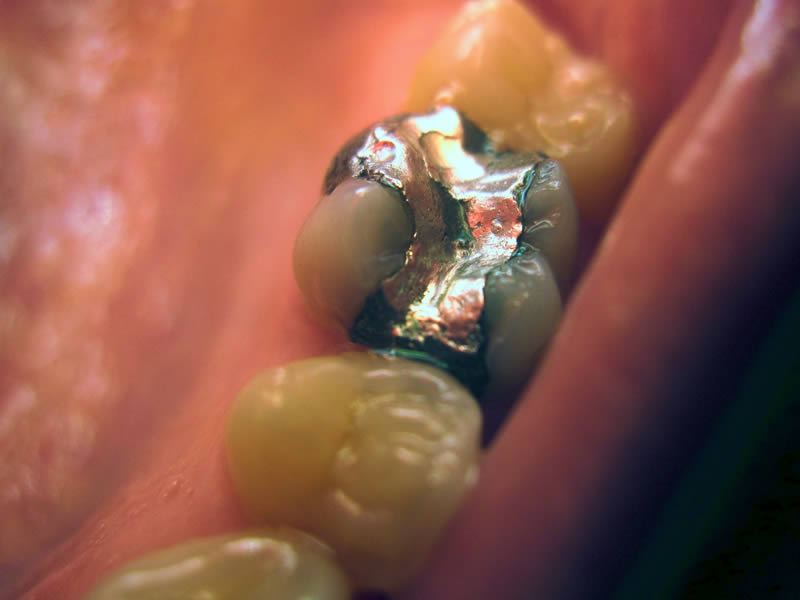 Amalgam Fillings